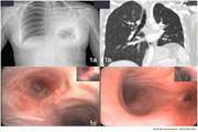 Fistula Formation Between the Right and Left Main Bronchus Caused by Endobronchial Tuberculosis